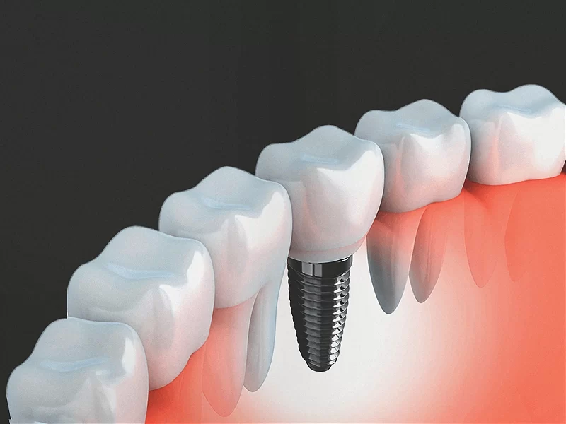 Tratamentos - Implantes